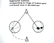 sem alinhamento ocular na esotropia