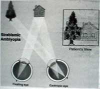 vis�o de uma casa sem alinhamento ocular na esotropia