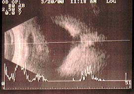 Ultrassonografia olho direito