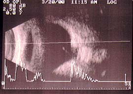 Ultrassonografia olho esquerdo