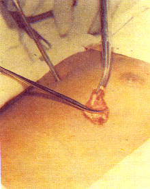 Imagem exibindo paciente sendo submetido &agrave; excis&atilde;o pulmonar extra tor&aacute;cica, onde v&ecirc;em-se pin&ccedil;as levantando a epiderme do mesmo deixando &agrave; mostra a cavidade por onde se pretende chegar &agrave; parede externa do pulm&atilde;o .