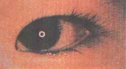 Hiperemia conjuntival