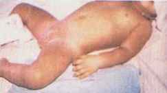 Dermatite perineal