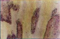 Imagem exibindo l&acirc;mina de microscopia &oacute;tica HE com aumento de 10 vezes, exibindo ninhos de c&eacute;lulas em estroma fibrilar