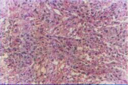 Imagem exibindo l&acirc;mina de microscopia &oacute;tica HE com aumento de 10 vezes, exibindo densidade celular aumentada, pleorfismo 
          nuclear