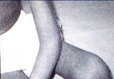 Imagem de paciente sentado com close em seu cotovelo, acometido de artrite