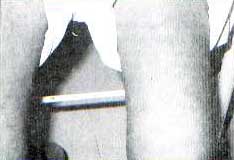 Imagem de paciente sentado com close em suas coxas, acometidas de artrite