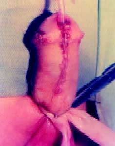 Glande sobre retalho