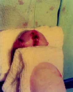 Compressão com gaze