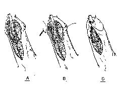 retalho da pele, avanço da glande e glande protegendo a neo-uretra