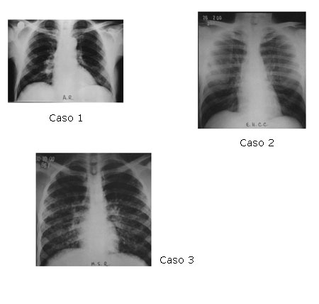 Radiografias de tórax dos três pacientes