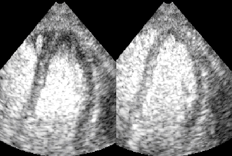 Imagem de ecocardiograma exibindo um corte 4 câmaras apical - Perfusão miocárdica normal em repouso (esquerda) e após infusão de nitroprussiato de sódio (direita)